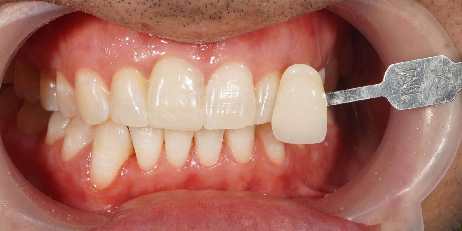 Picasso Glow result, after treatment